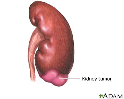 Kidney mass