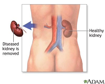 kidney removal
