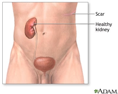 one kidney with scar