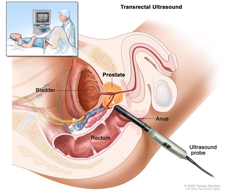 Transrectal ultrasound. An ultrasound probe is inserted into the rectum to check the prostate. The probe bounces sound waves off body tissues to make echoes that form a sonogram (computer picture) of the prostate.