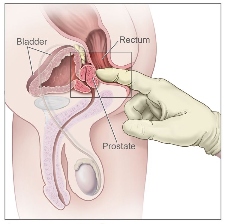 Digital rectal exam (DRE). The doctor inserts a gloved, lubricated finger into the rectum and feels the rectum, anus, and prostate (in males) to check for anything abnormal.