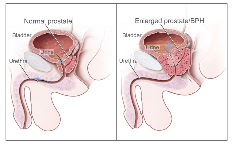 Normal prostate and benign prostatic hyperplasia (BPH). A normal prostate does not block the flow of urine from the bladder. An enlarged prostate presses on the bladder and urethra and blocks the flow of urine.