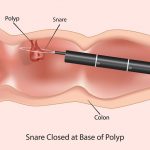 polypectomy