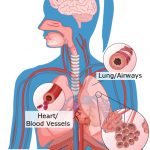 shortness of breath (dyspnea)