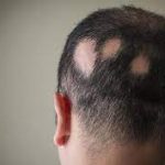 Hair loss (alopecia)