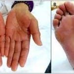 Hand Foot Syndrome