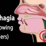 Dysphagia (painful swallowing)