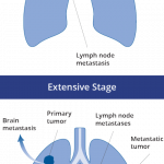 Lung cancer sc staging