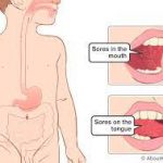 Mucositis (mouth sore)