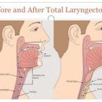 Total laryngectomy