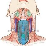Selective neck dissection