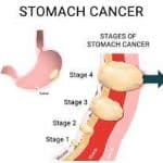 Stomach (gastric) cancer